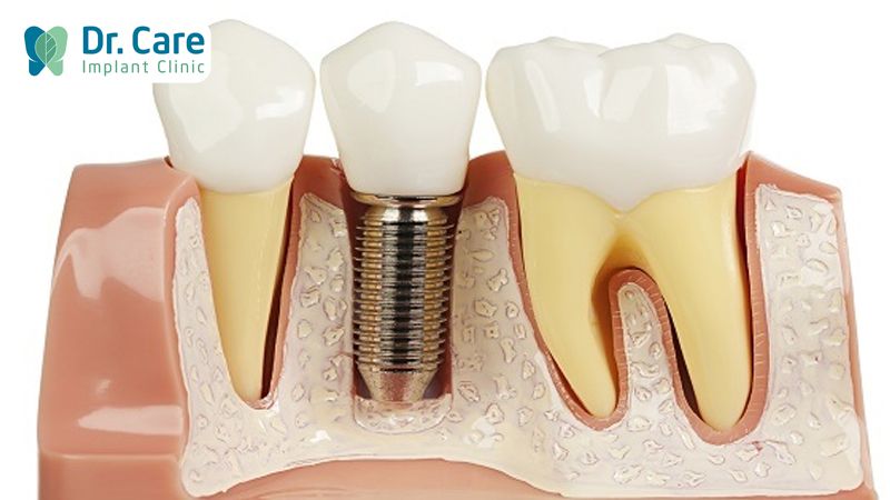 Trồng răng Implant ngăn chặn hôi miệng hiệu quả