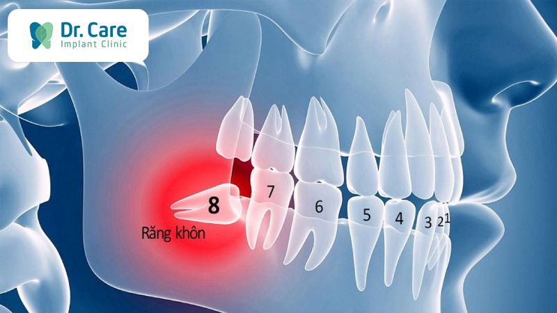 Răng khôn là răng nào? Mỗi người có bao nhiêu răng khôn?