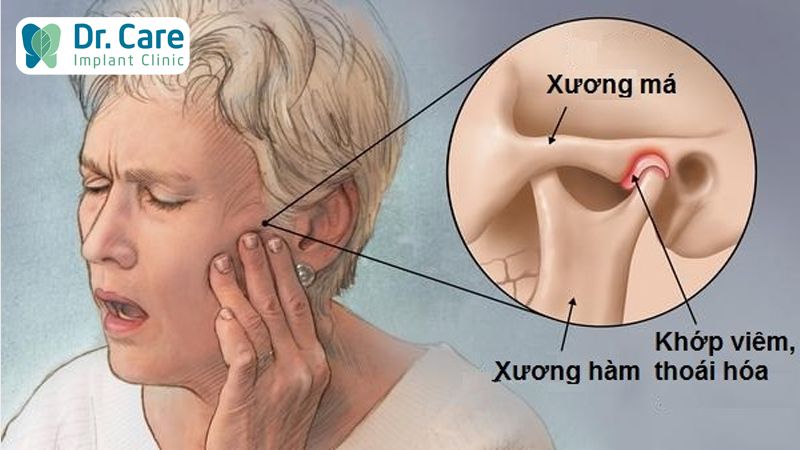 Ảnh hưởng tới khớp thái dương hàm