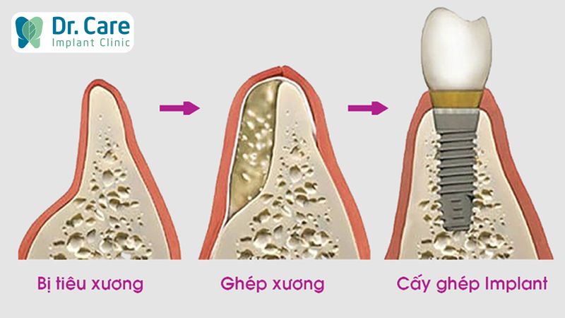 Lưu ý khi phục hồi răng ở người cao tuổi bị tiêu xương hàm