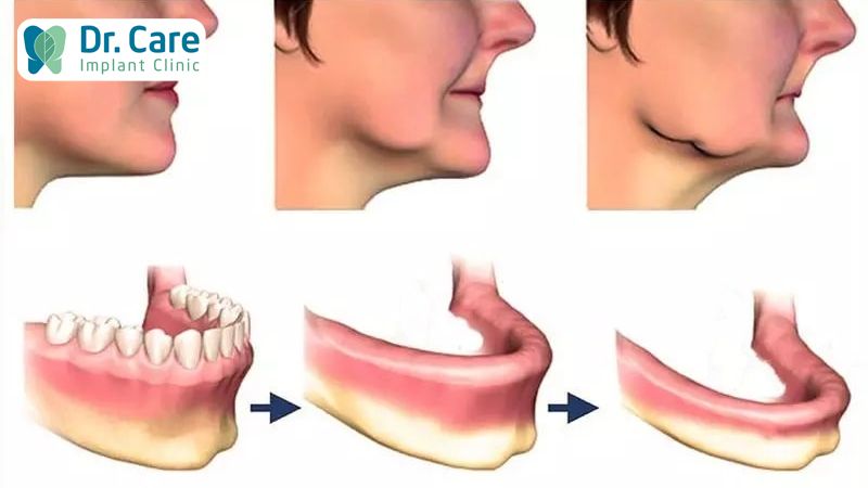 Mất răng bao lâu thì tiêu xương hàm?