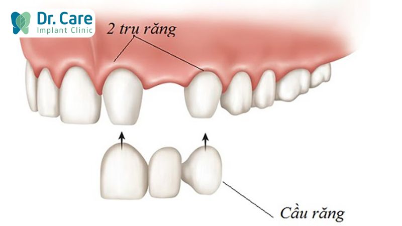 Cầu răng sứ