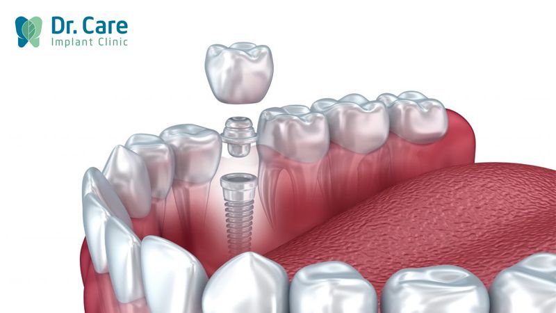 Trồng răng Implant