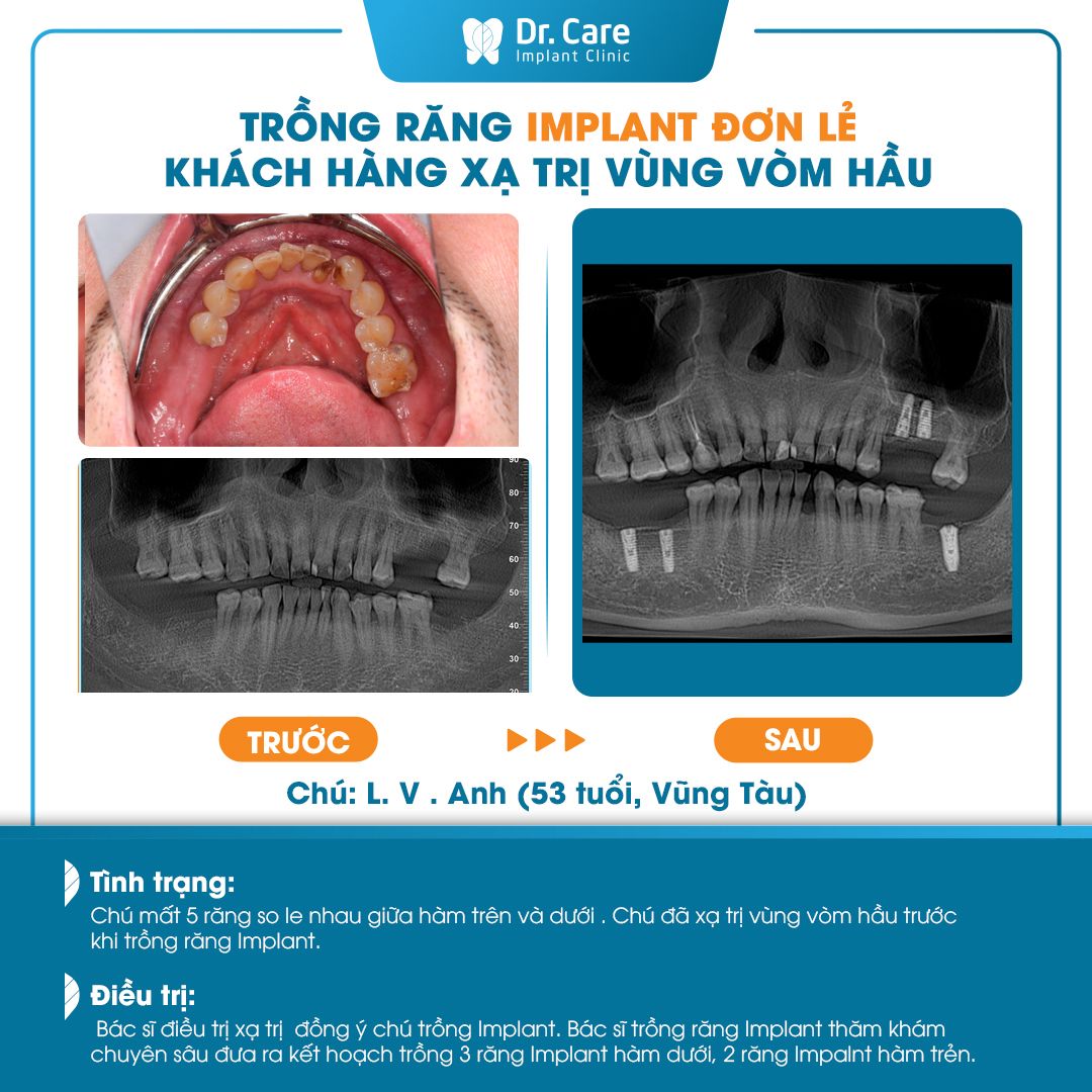 Trồng răng Implant cho người bị ung thư an toàn, không đau