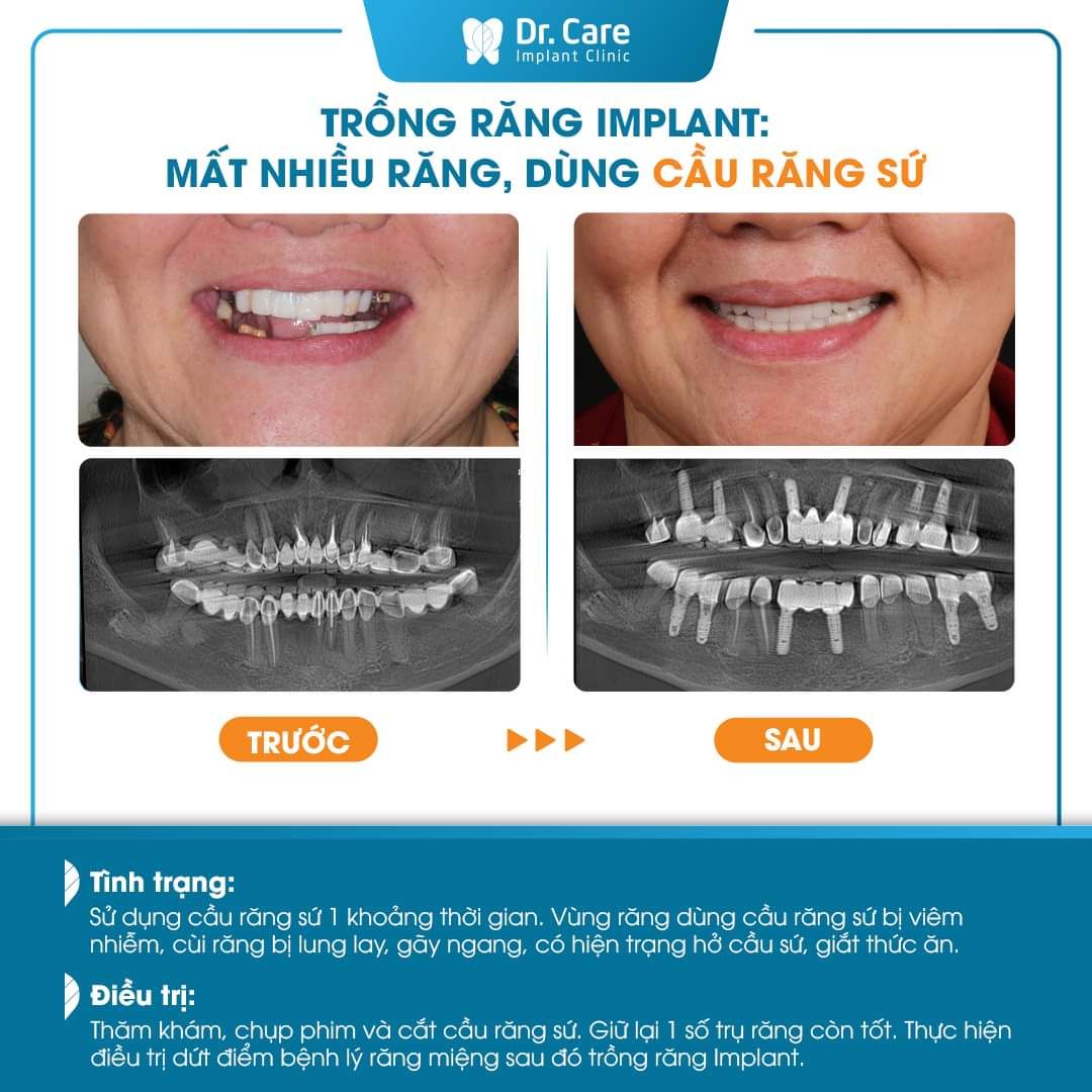 Phục hồi cầu răng sứ hỏng bằng trồng răng Implant