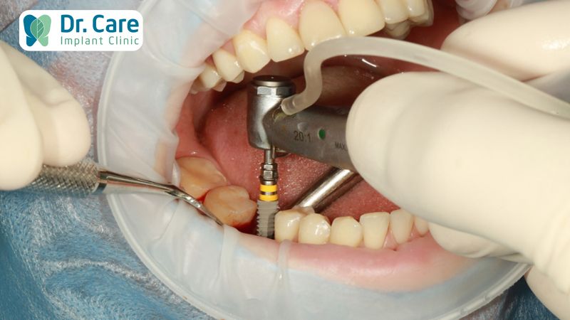 Cấy Implant tức thì rút ngắn thời gian điều trị