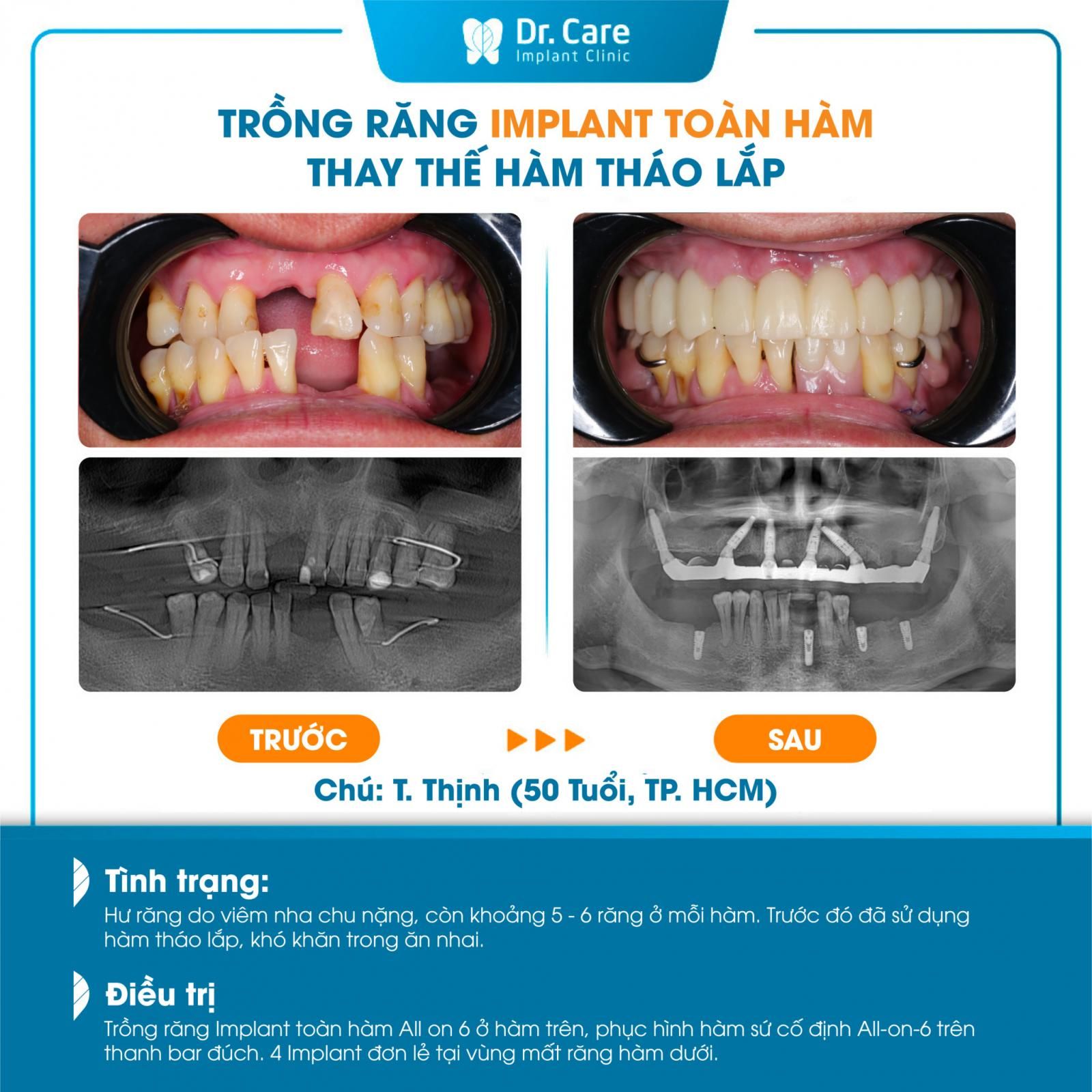 Trồng răng Implant thay thế hàm tháo lắp