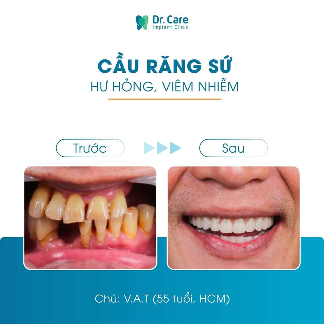 Trồng răng Implant thay thế cầu răng sứ