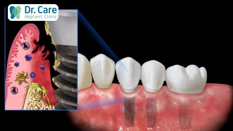 Hút thuốc lá có thể gây đào thải trụ Implant