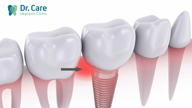 Sử dụng chất kích thích sau trồng Implant tăng nguy cơ viêm nhiễm