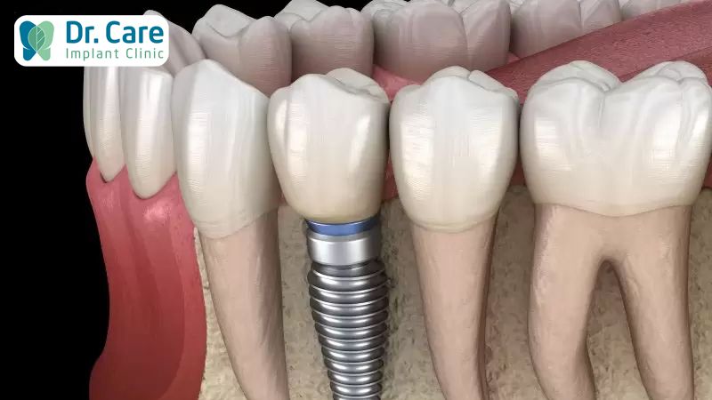 Làm răng giả cố định bằng cấy ghép Implant (trồng răng implant)