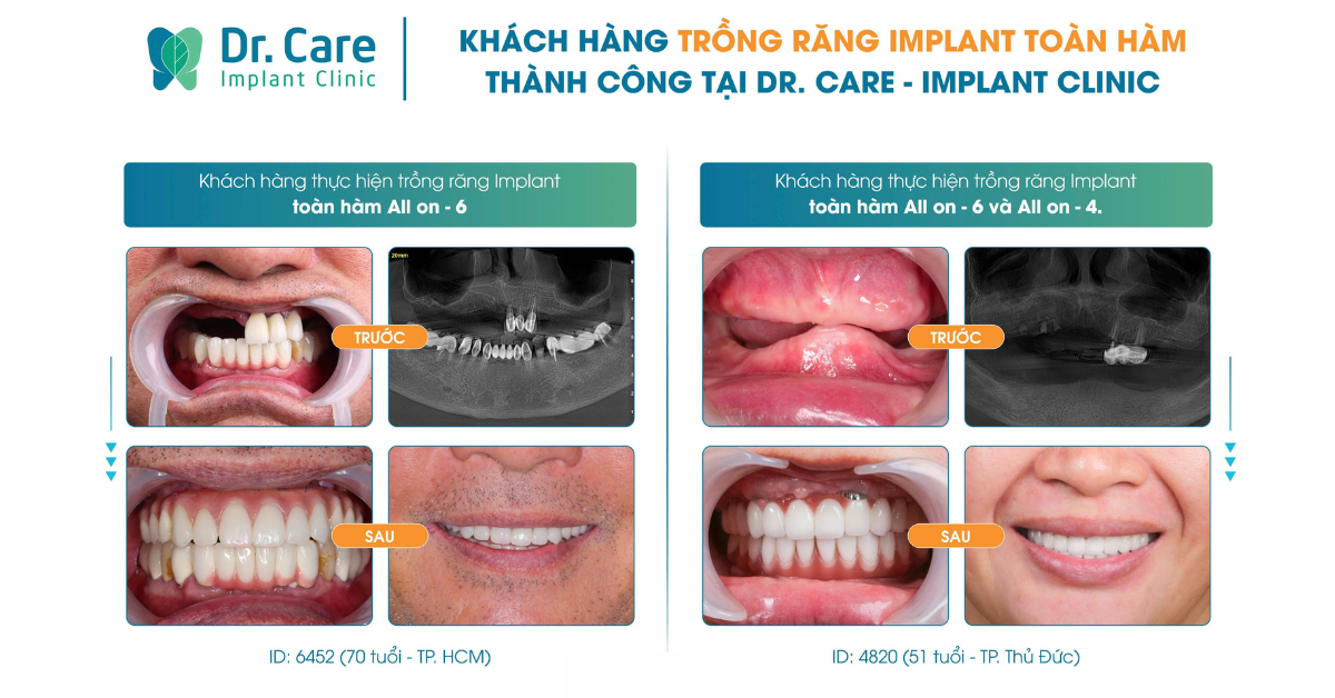 Trồng răng Implant có ưu điểm vượt trội là độ bền lâu dài từ 20 năm