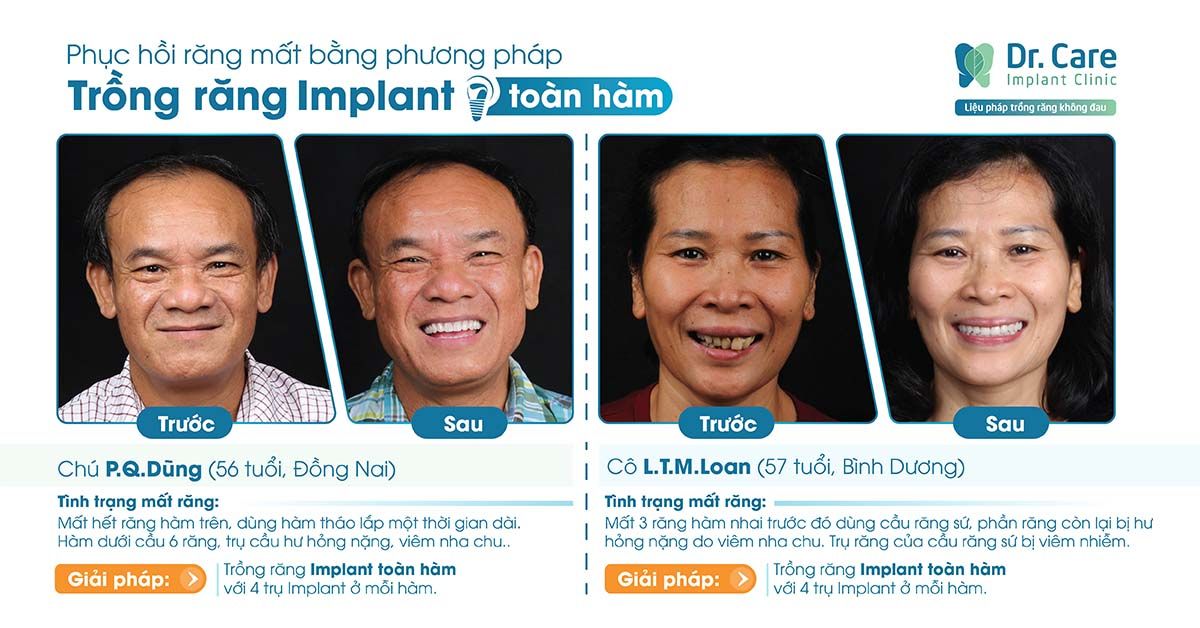 Mất răng lâu năm khôi phục bằng trồng răng Implant Hàn Quốc