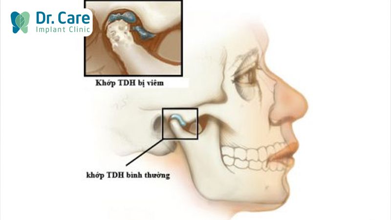 Nhiễm khuẩn khớp