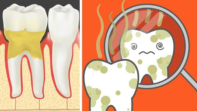 Do chưa điều trị hết các bệnh lý răng miệng trước khi cấy ghép