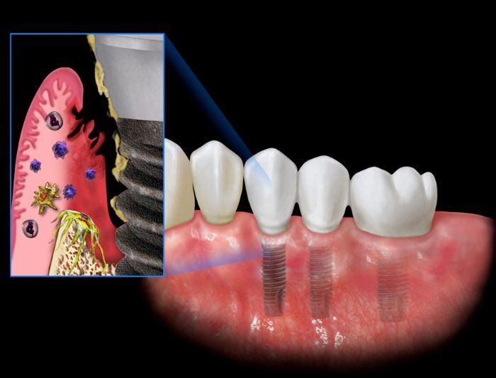 Do nhiễm trùng sau khi trồng răng Implant