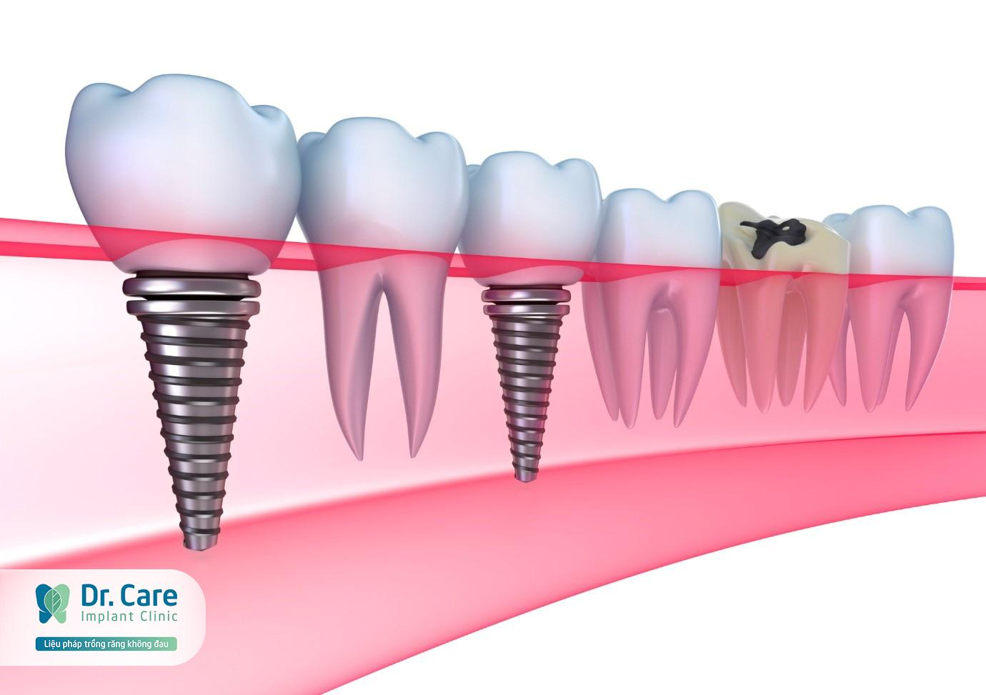 Xương hàm đạt tiêu chuẩn để cấy ghép Implant