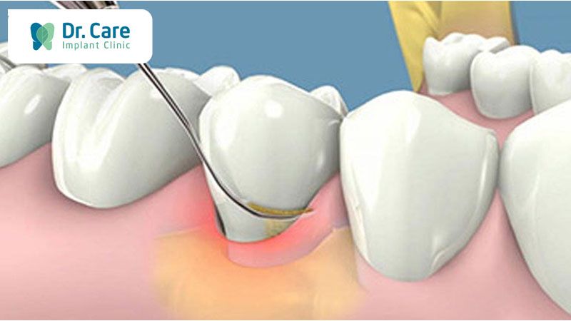 Điều trị khi trình trạng tụt nướu có diễn biến nặng