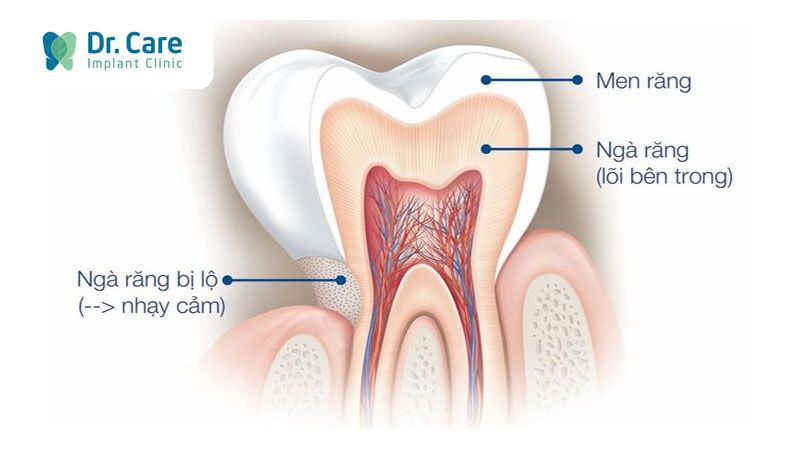 Răng trở nên nhạy cảm hơn