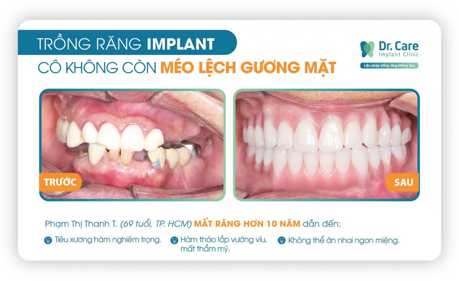 Khách hàng trồng răng Implant tại Dr. Care