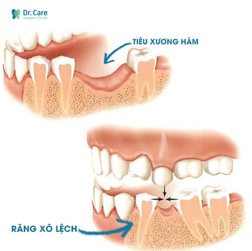 Khiến các răng còn lại xô lệch