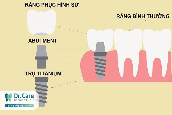 Trồng răng Implant phục hồi chức năng ăn nhai khắc phục tình trạng khó ăn ở người lớn