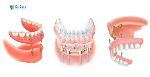 Hàm răng giả tháo lắp trên Implant