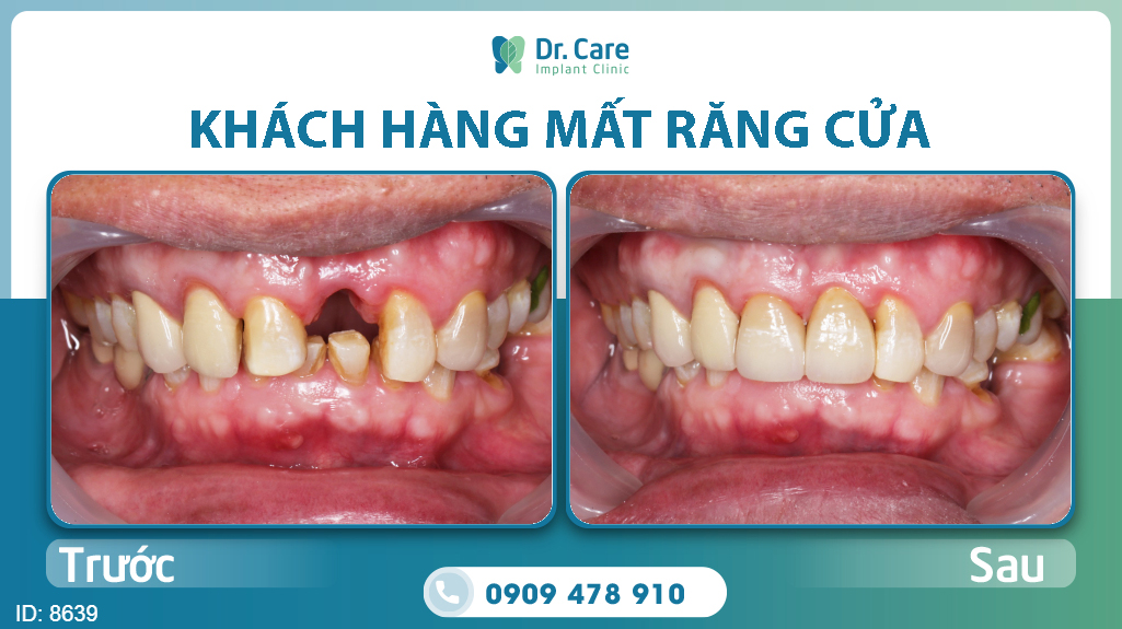 Khách hàng phục hồi răng Implant tại Dr. Care 