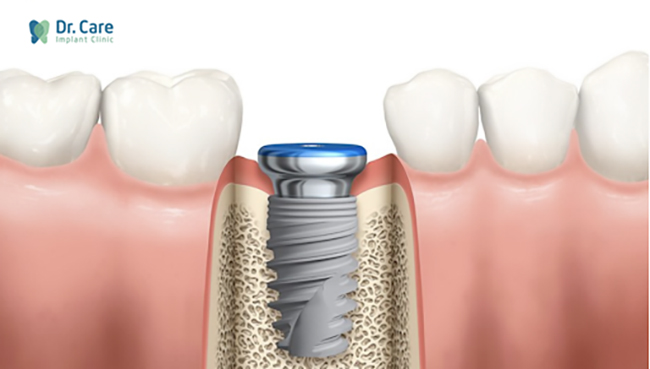 Trồng răng Implant - phục hồi răng đã mất khắc phục lồi xương chân răng