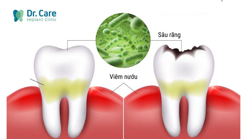 Thói quen lười đánh răng gây sâu răng