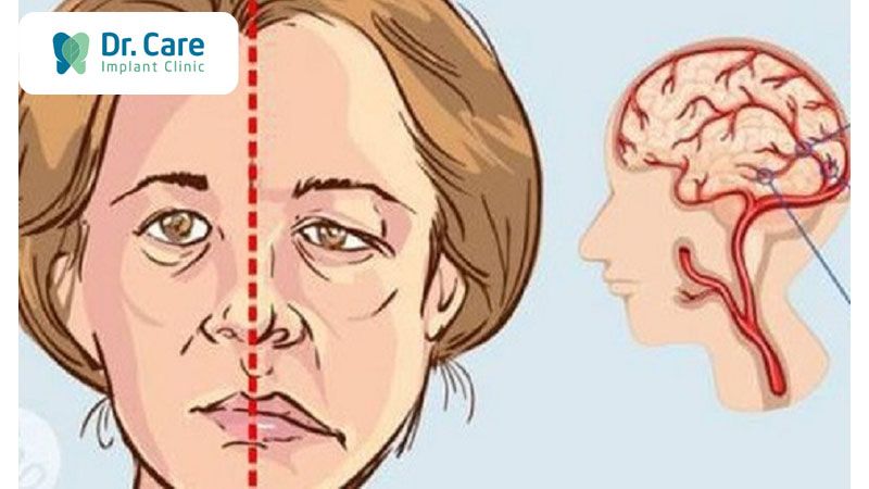 Gương mặt lệch, móm mém, già trước tuổi