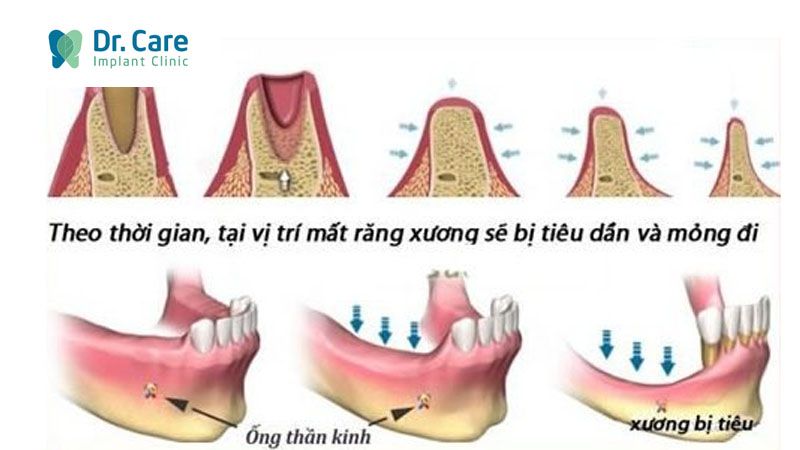 Tiêu xương hàm, tụt nướu