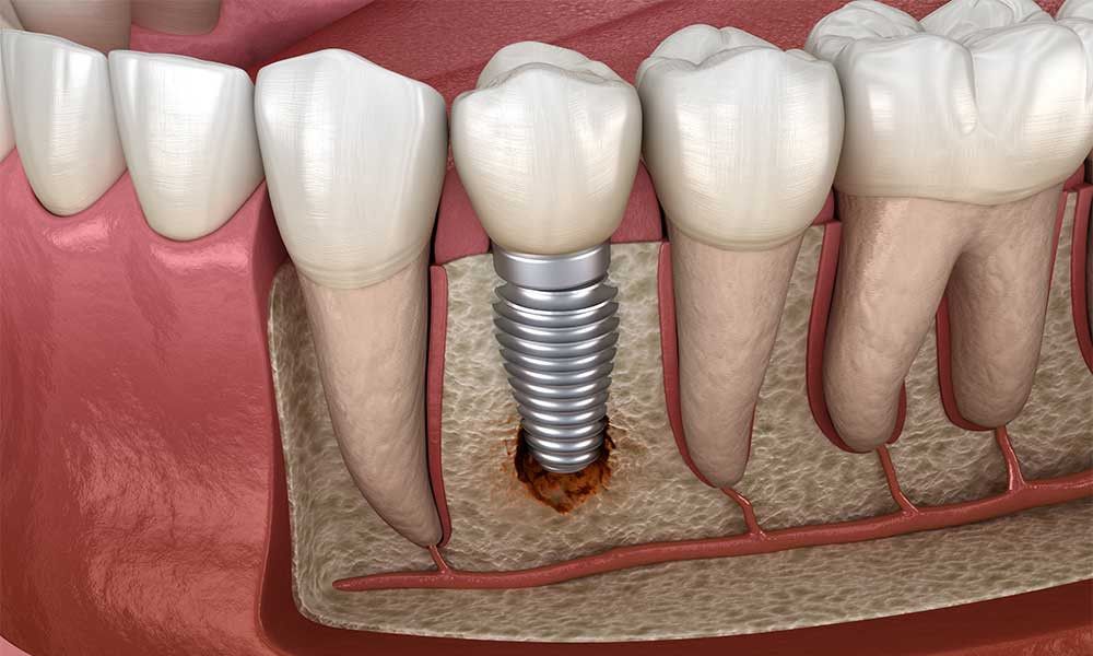 Hiện tượng đào thải trụ Implant