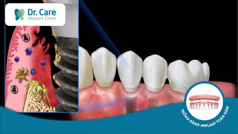 Nhiễm trùng vùng cấy ghép Implant là gì?