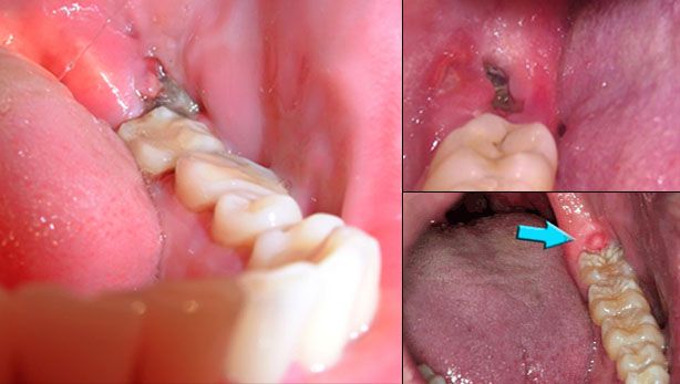 Nhiễm trùng ổ răng sau khi nhổ