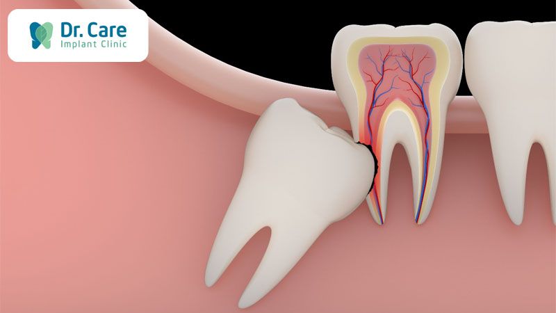 Răng khôn là gì? Nằm ở vị trí nào?