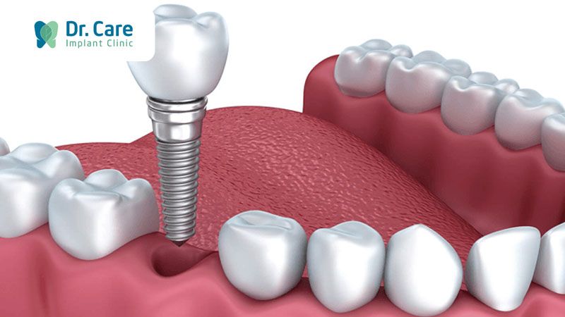 Là phương pháp phục hồi duy nhất có chân răng cố định