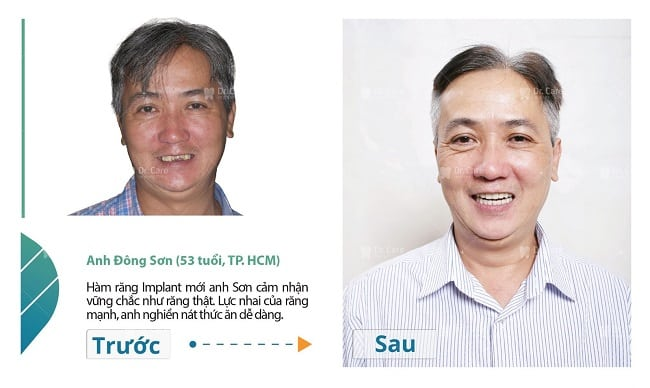 Trồng Implant uy tín tại nha khoa Dr. Care