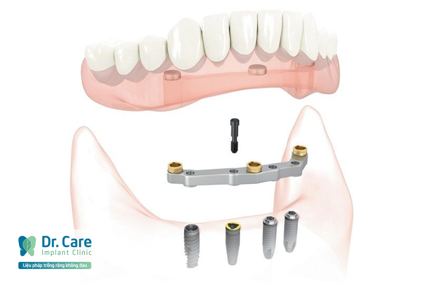 Bước 8: Thử khung sườn Titanium CAD/CAM