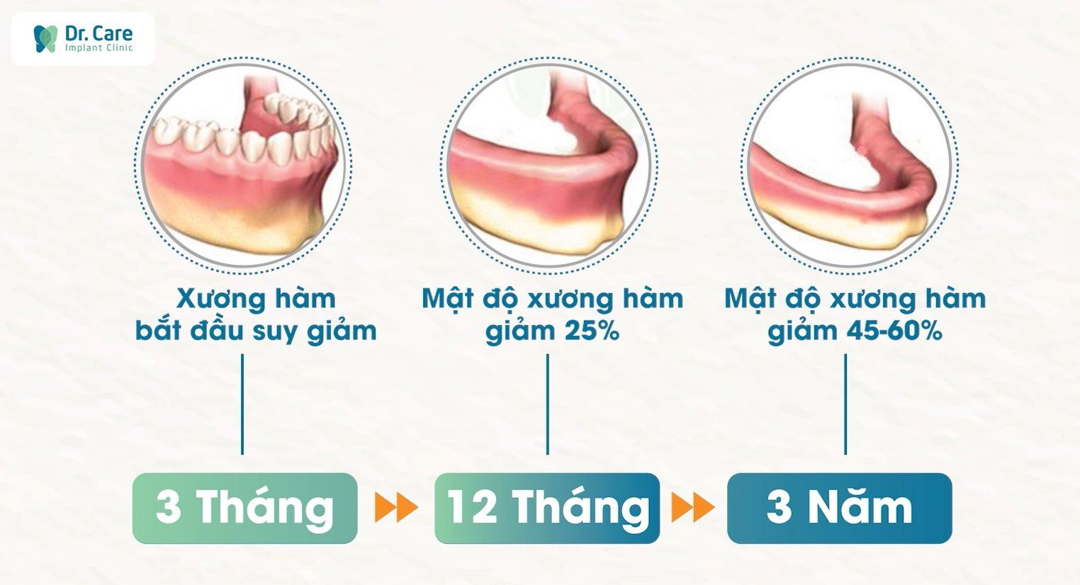 Nguy cơ biến chứng tiêu xương hàm