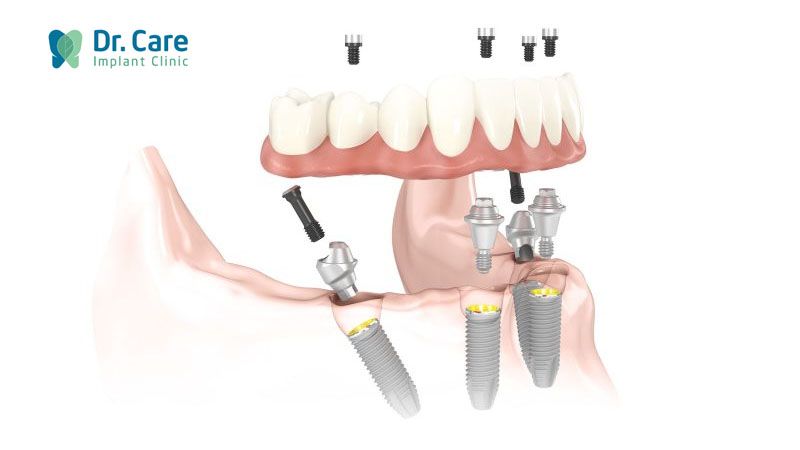 Nên dùng hàm răng giả tháo lắp loại nào tốt nhất?