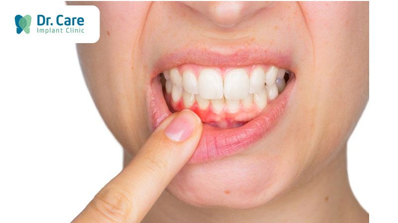 Dị ứng răng sứ kim loại trên Implant phải làm sao?