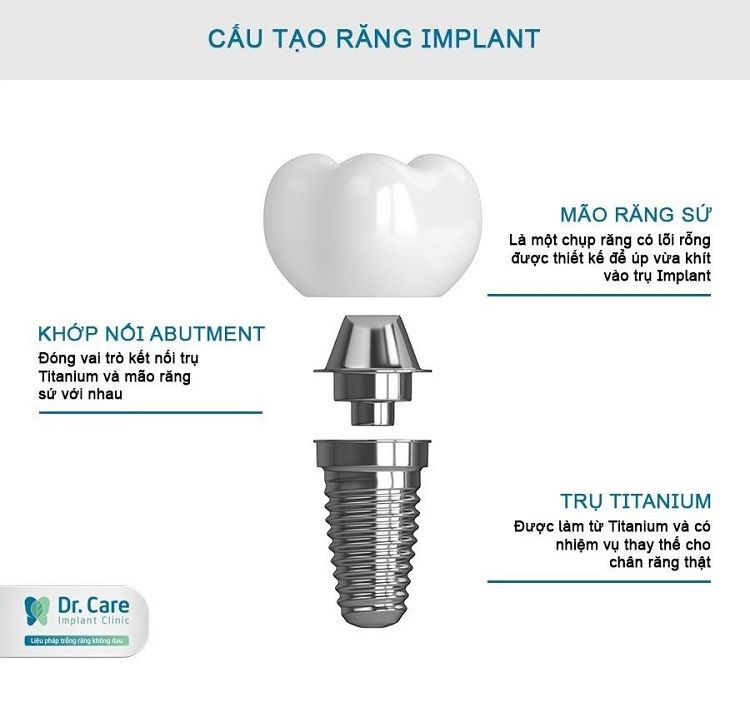 Răng Implant có cấu tạo gồm 3 thành phần