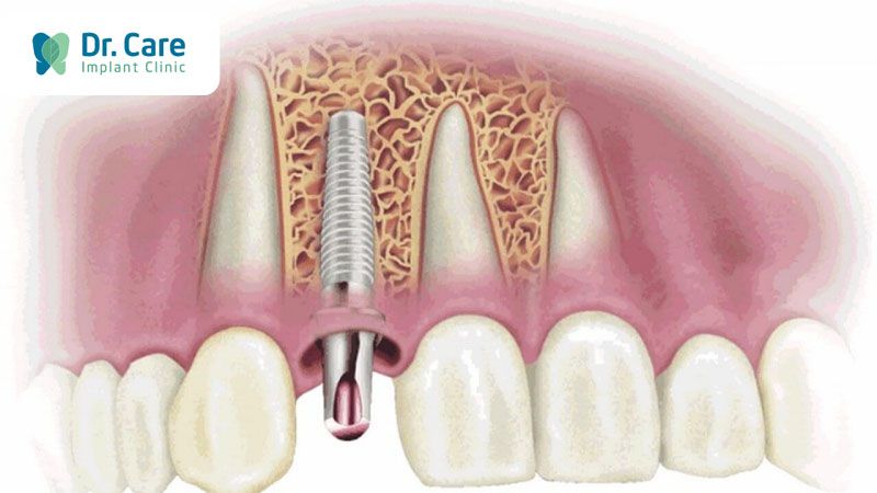 Trụ Implant bị đào thải hoặc gãy