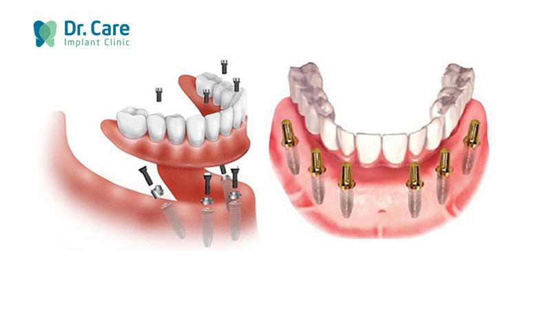 Chi phí trồng răng Implant hàm dưới mất bao nhiêu tiền