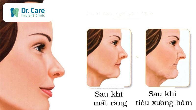 4 Hậu quả nghiêm trọng khi mất răng hàm trên