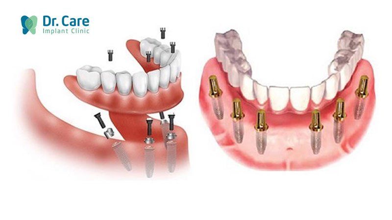 Trồng răng Implant toàn hàm trên bằng kỹ thuật All On-4 và All On-6