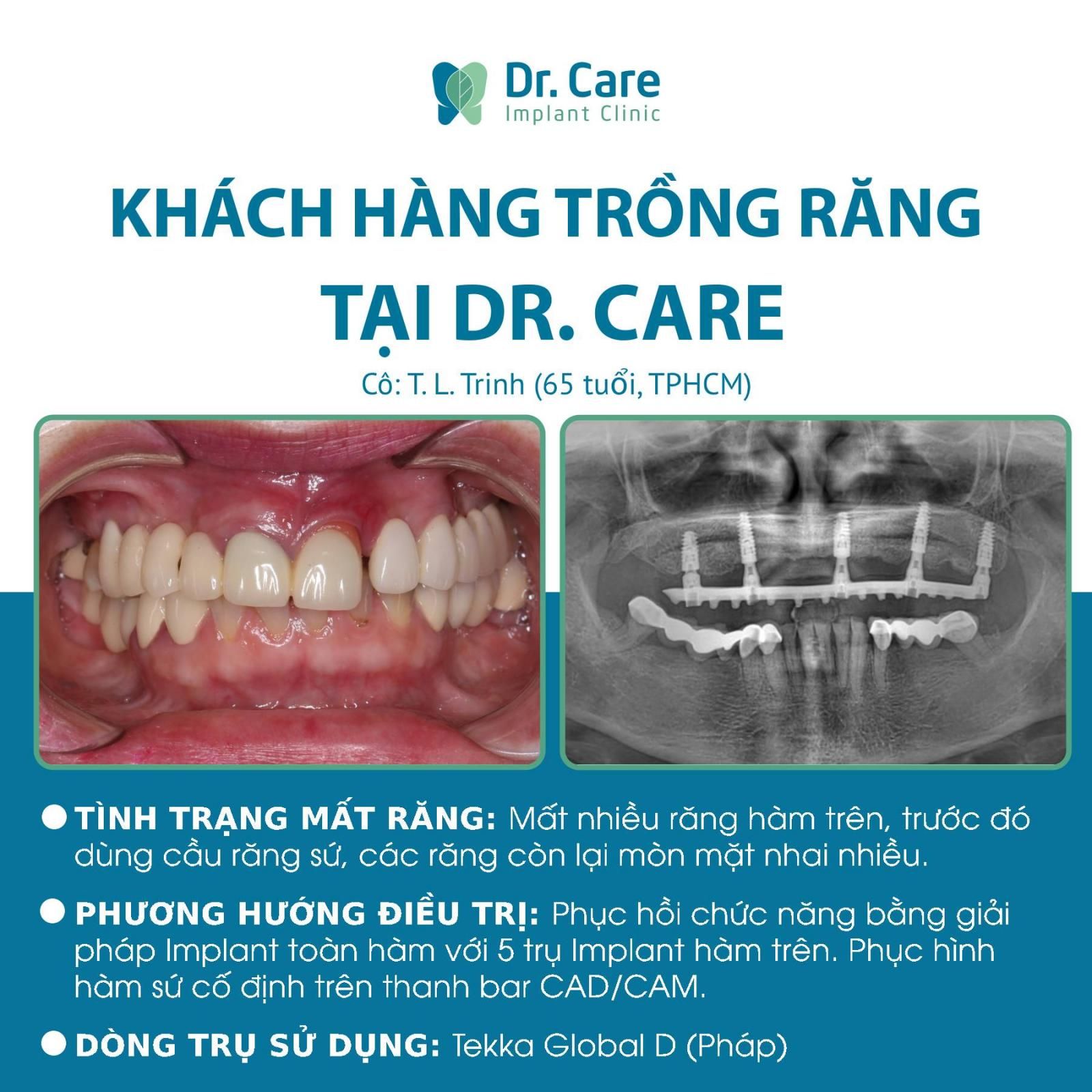 Nhận xét của Khách hàng sau khi trồng răng Implant toàn hàm tại Dr. Care - Implant Clinic