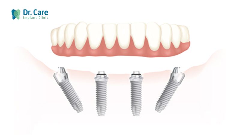 Phương pháp trồng răng Implant toàn hàm là gì? 