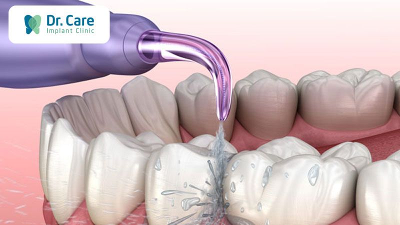 Vệ sinh răng Implant bằng tăm nước đúng cách